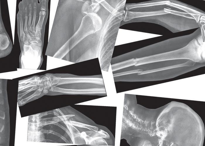RoylcoÂ® Broken Bones X-Rays